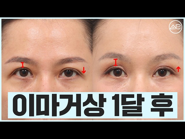 50대 이마거상 1달차 전후 비교 | 에이비성형외과