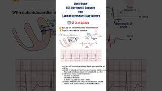 Must-Know ECG Rhythms &amp; Changes for Cardiac Intensive Care Nurses  #echocardiography