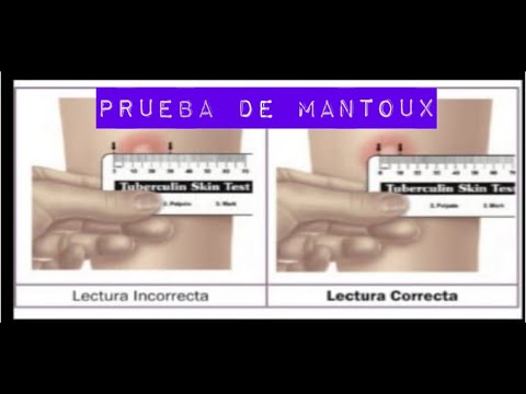 Prueba cutánea de la tuberculina o prueba de Mantoux / Técnica