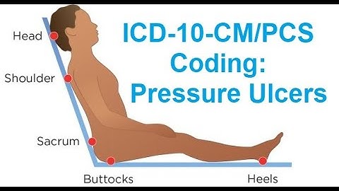 ICD-10-CM/PCS: Pressure Ulcers
