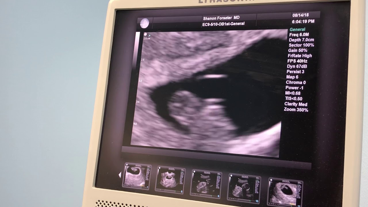 8w1d Tv Ultrasound Youtube 8w1d Tv Ultrasound Youtube