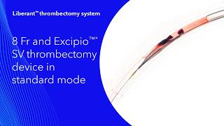 Liberant™ thrombectomy system: 8 Fr and Excipio™* SV thrombectomy device in standard mode