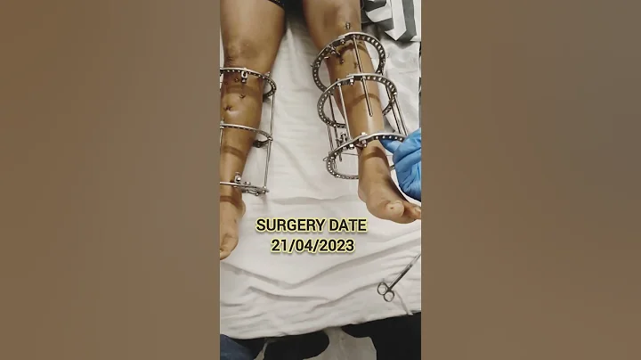 Height Increase Surgery | Surgery For Height | Limb Lengthening Surgery In Delhi - DayDayNews