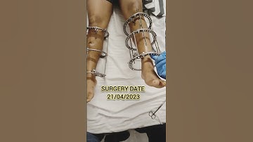 Height Increase Surgery | Surgery For Height | Limb Lengthening Surgery In Delhi