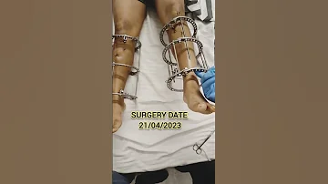 Height Increase Surgery Surgery For Height Limb Lengthening Surgery In Delhi 