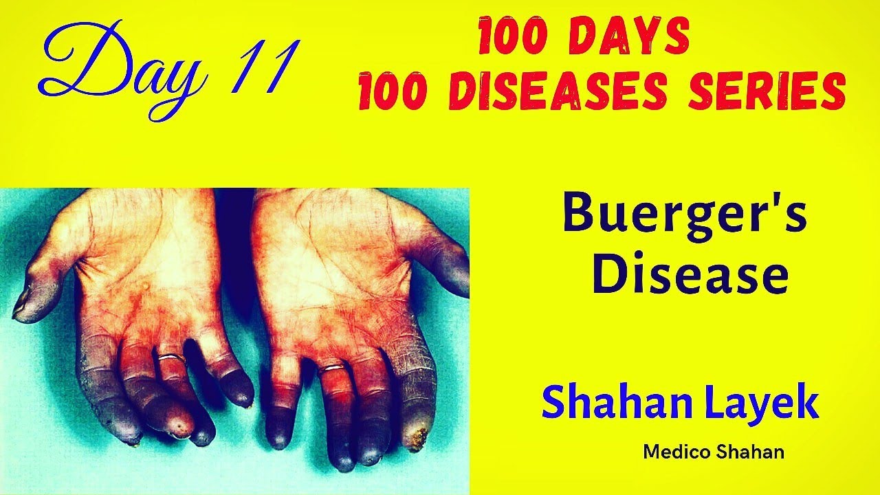 Buerger's Disease 100 Days 100 Disease series Shahan Layek YouTube