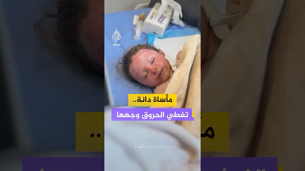 طفلة من قطاع #غزة لم تتخط عامها السادس أصيبت بحروق خطرة جراء نيران الاحتلال