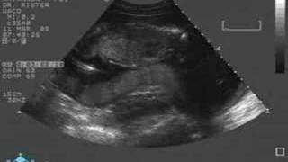 Baby boy ultrasound