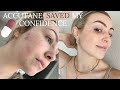 Filming my Accutane Journey