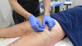 Subscision and Sculptra for Treating Cellulite with Dr. Janowski