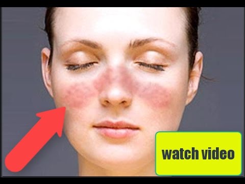 Home remedies for
