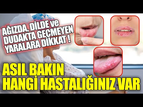 Ağzıda Dilde ve Dudakta Geçmeyen Yaranın Asıl Nedeni...