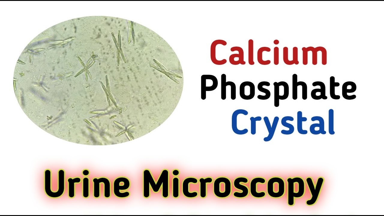 calcium phosphate crystal I Tanu Path - YouTube