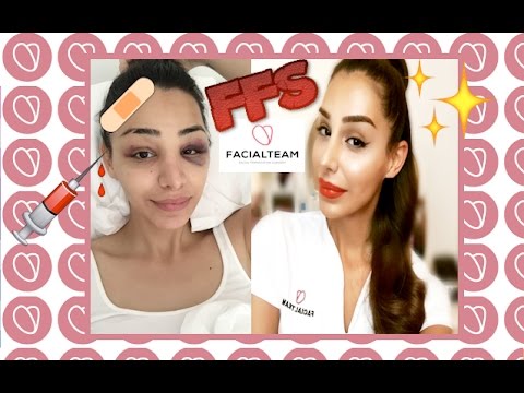 FFS - MY FOREHEAD BOSSING/REDUCTION WITH FACIALTEAM | Pari