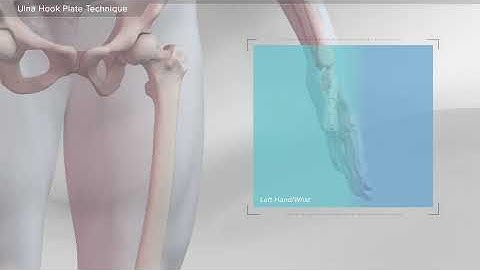 Ulna Hook Plate Technique