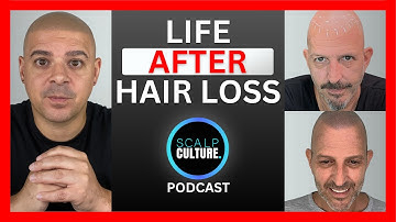 How Scalp Micropigmentation Changed My Life!