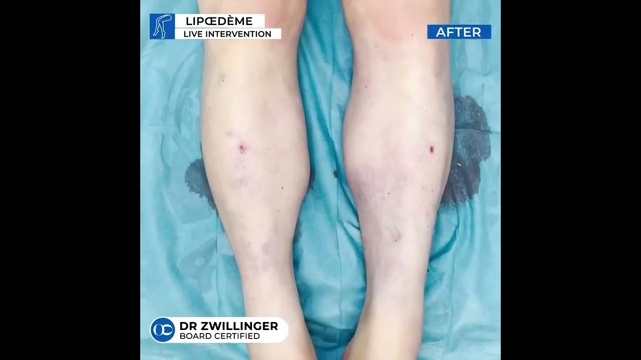 Dr Nicolas Zwillinger - le pionnier du traitement du lipoedème en