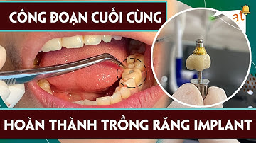 Răng Giả Implant Được Lắp Cố Định Như Thế Nào Mà Lại Chắc Chắn Như Răng Thật??