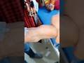 cannulation.. video.. part 436 #shorts #viral #trending