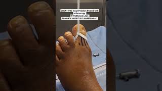 Great Toe Arthroscopy For Gouty Arthritis