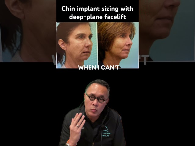 Chin implant sizing with deep-plane facelift