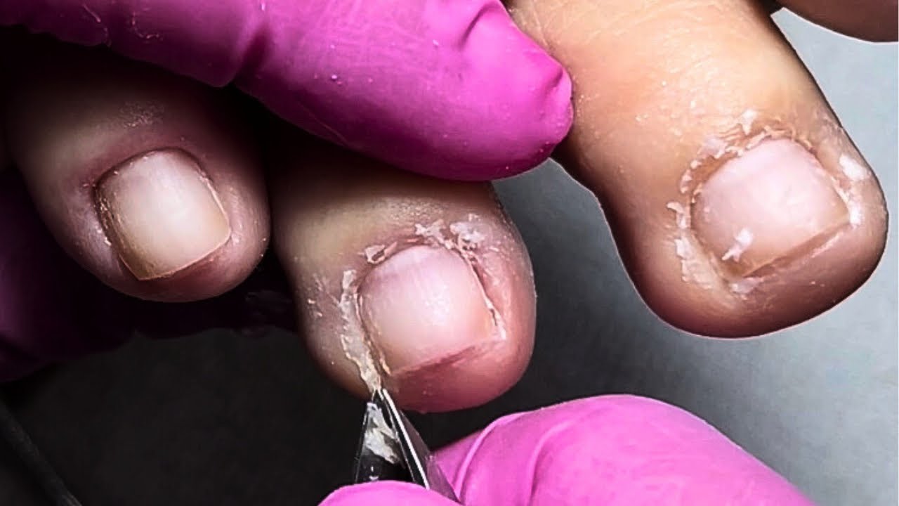 Técnica Simples para Tirar Cutículas dos Pés (Funciona!)