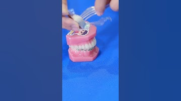 ĐỒ ĂN NÀO AN TOÀN CHO RĂNG NIỀNG: Kẹo SOCOLA #drcuong #nhakhoa #niengrang