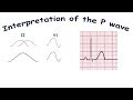 Interpretation of the P wave