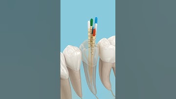 Dental root canal filling procedure. 3D Animation