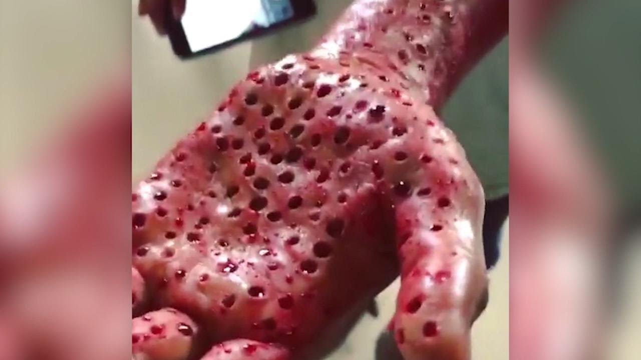 ×ª××¦××ª ×ª××× × ×¢×××¨ âªtrypophobiaâ¬â