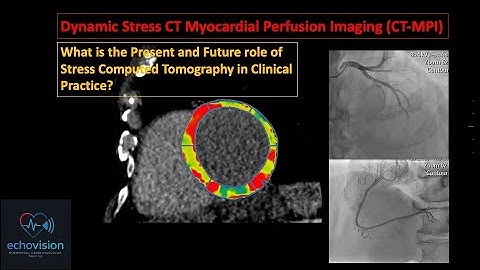 Dynamic Stress CT Myocardial Perfusion Imaging (CT MPI)