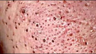 DR Skincare #acne #blackheads#whiteheads, #Treatments #pimple# Part 8 Full Screen HD