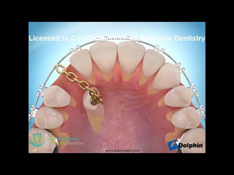 Impacted Tooth (Top of Mouth) | City Orthodontics & Pediatric Dentistry Edmonton