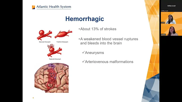 Stroke and Hypertension