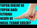 Topuk Dikeni ve Topuk Bağı İltihabı Nedir ve Nasıl Tedavi Edilir?