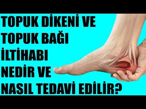 Topuk Dikeni ve Topuk Bağı İltihabı Nedir ve Nasıl Tedavi Edilir?