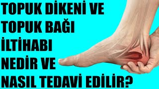 TOPUK DİKENİ VE TOPUK BAĞI İLTİHABI NEDİR VE NASIL TEDAVİ EDİLİR? Resimi