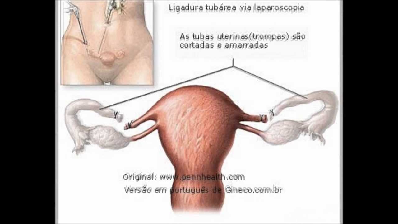 O que é Laqueadura? - YouTube