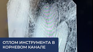 Отлом инструмента в корневом канале