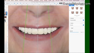 How to do a comprehensive smile design using Keynote