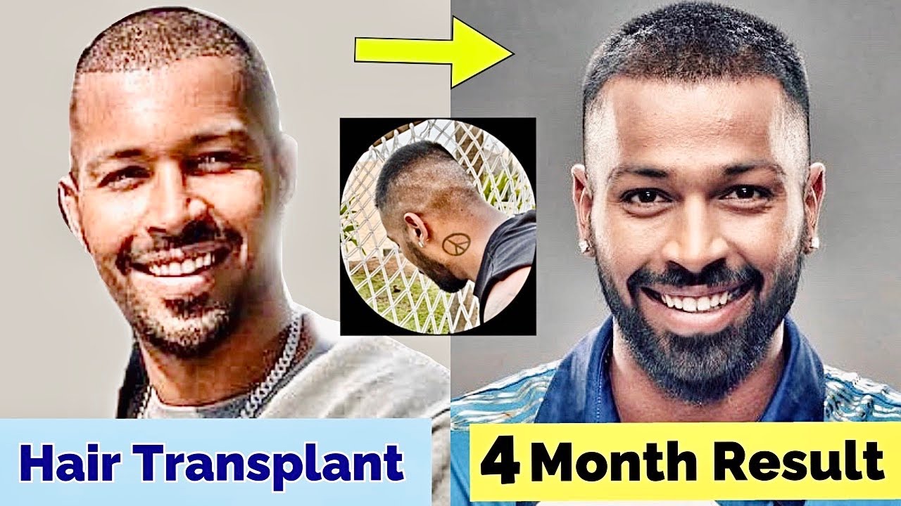 Hardik Pandya Amazing Hair Transplant Result Just in 4 Month | Celebrity Hair  Transplant | IPL 2021 - YouTube