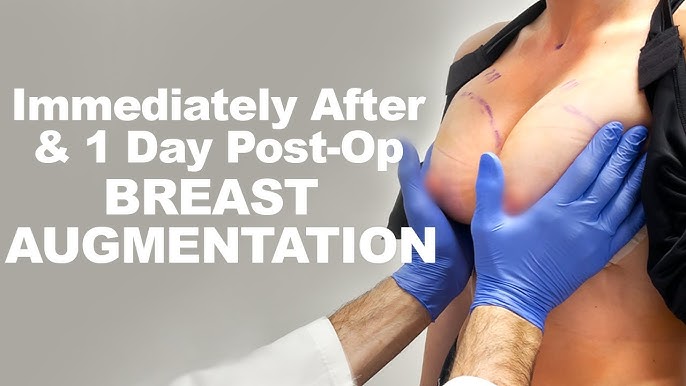 What To Expect During Breast Augmentation Recovery Day By Day