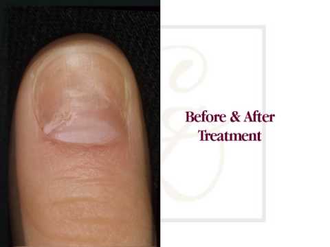 Nail Fungus Treatment - Before & After Images - YouTube