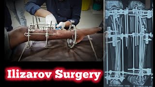 Ilizarov Surgery Of Dhoulpur Patient. Ilizarov Frame Modified Ilizarov Frame Remove