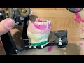 Complete maxillarymandibular dentures setup bilateral crossbite part 3