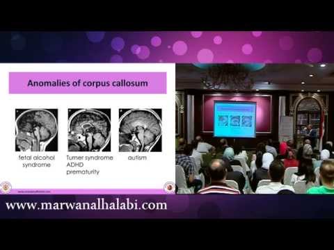 شذوذات الجسم الثفني Corpus Callosum Anomalies - الأستاذ الدكتور مروان الحلبي