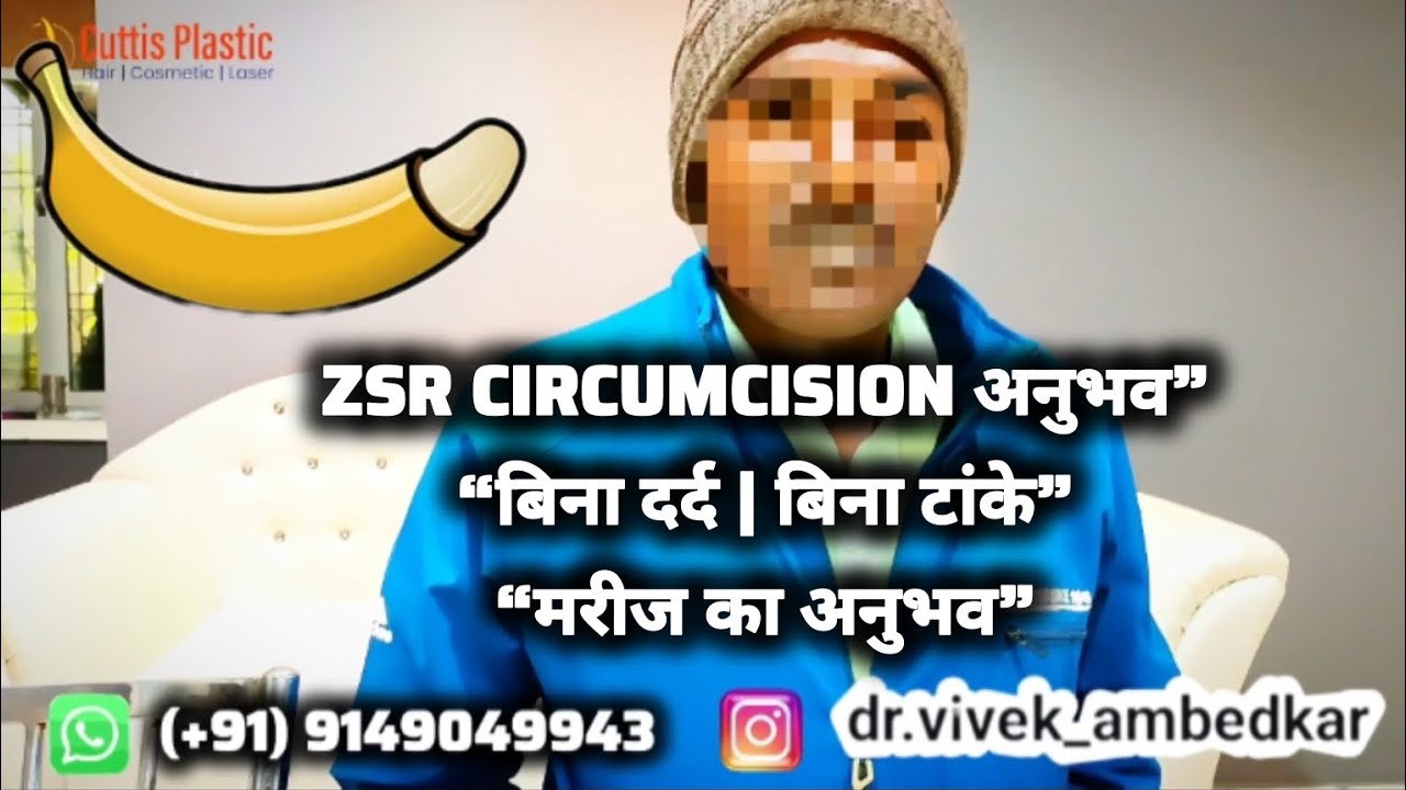 ZSR Circumcision Surgery Experience & Result | No Stitches No Pain | बिना दर्द की सर्जरी | Rewa MP