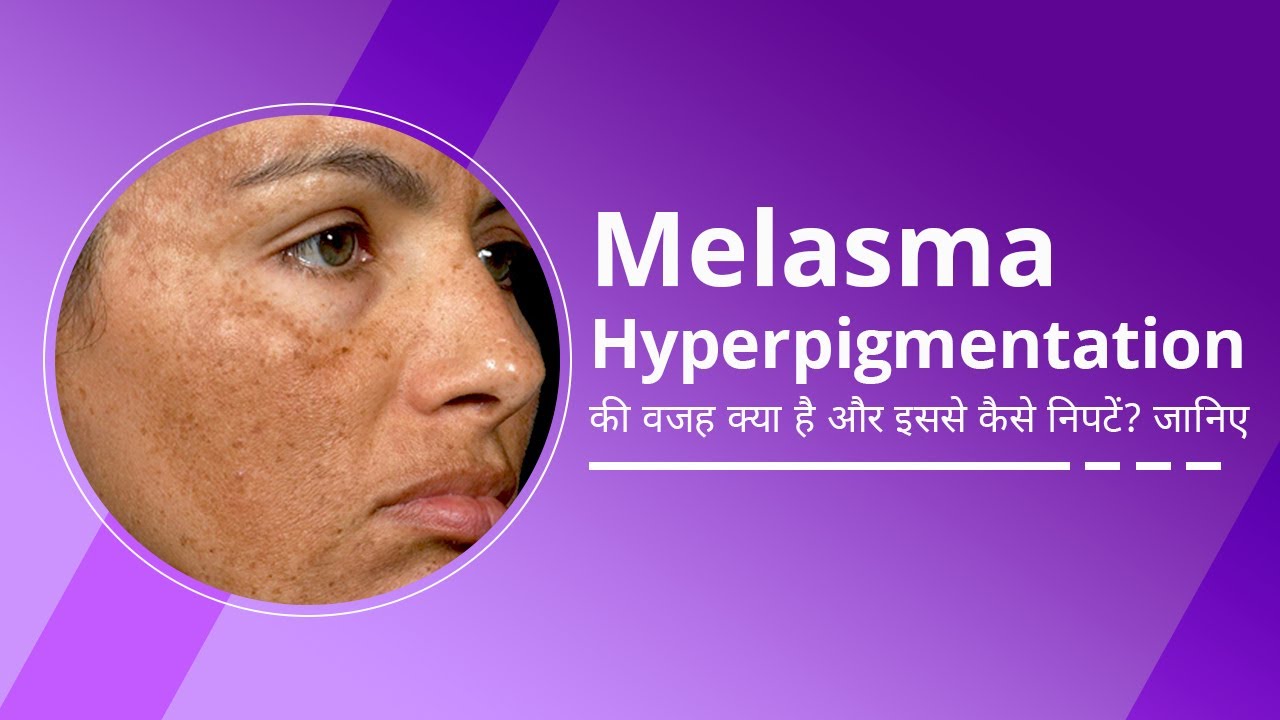 What is Melasma/Hyperpigmentation Melasma Treatment cream Melasma