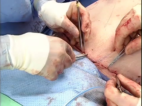 Belt Lipectomy Male Patient - Live Surgery Part 2