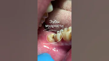 Удаление зуба мудрости